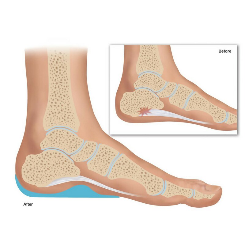 Plantar Fasciitis